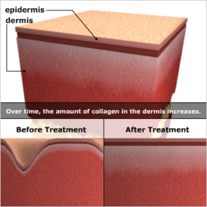laser resurfacing